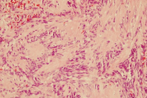 Intranodal palisaded myofibroblastoma with a thin rim of residual lymph node