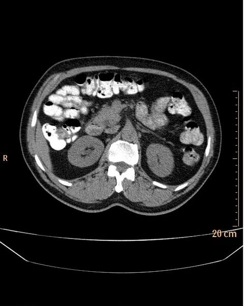 File:Abdominal aortic aneurysm (Radiopaedia 25985-26121 Axial non-contrast 3).jpg