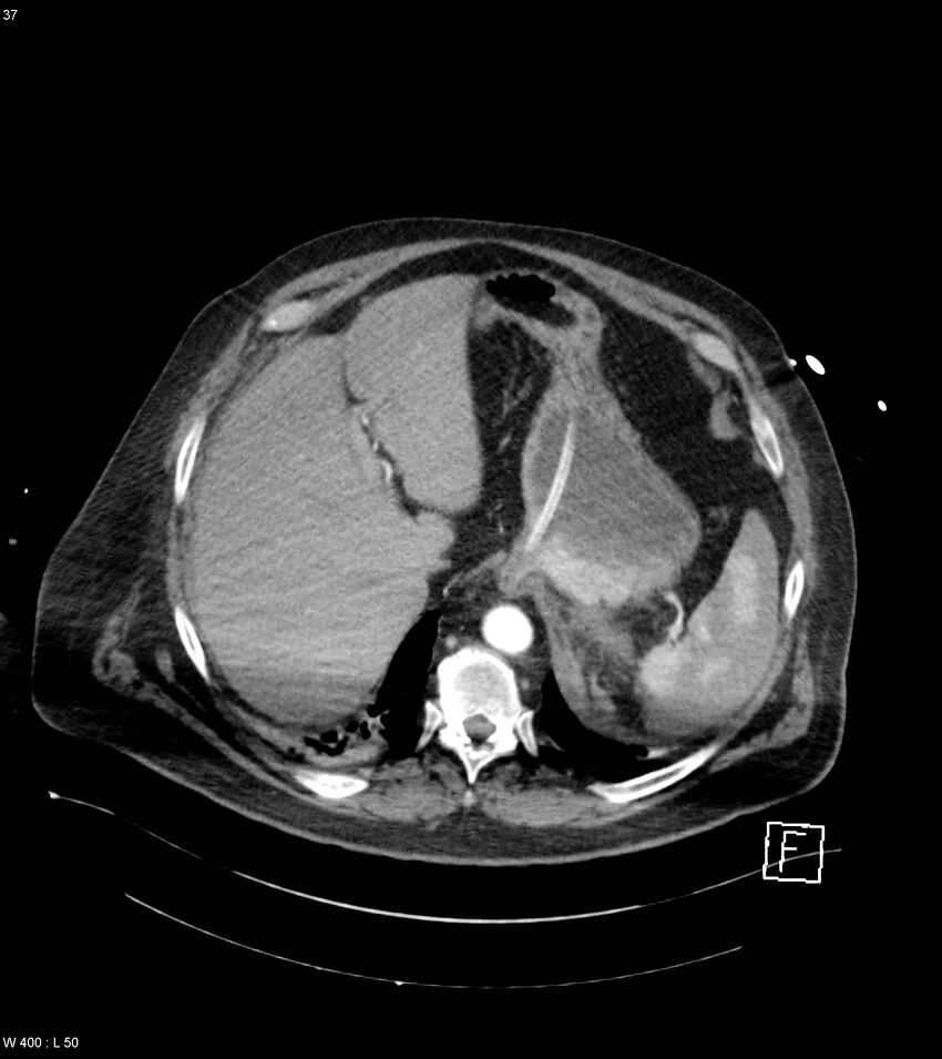 Abdominal aortic aneurysm with intramural hematoma then rupture (Radiopaedia 50278-55632 Axial C+ arterial phase 36).jpg