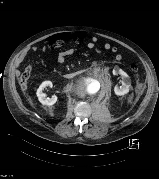 File:Abdominal aortic aneurysm with intramural hematoma then rupture (Radiopaedia 50278-55632 Axial C+ arterial phase 80).jpg