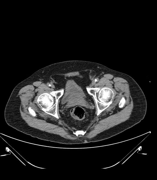 File:Abdominal aortic aneurysm with thrombus fissuration (Radiopaedia 46218-50618 Axial non-contrast 55).jpg