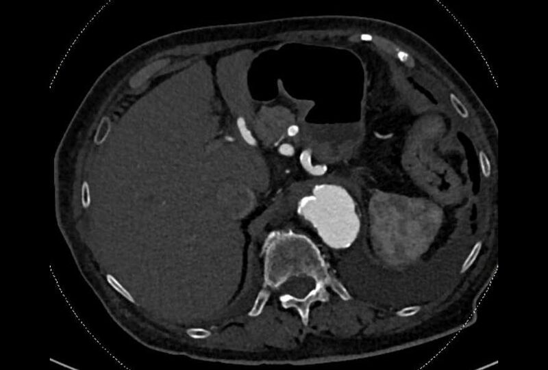 File:Abdominal aortic aneurysm with thrombus fissuration (Radiopaedia 73192-83919 Axial C+ arterial phase 24).jpg