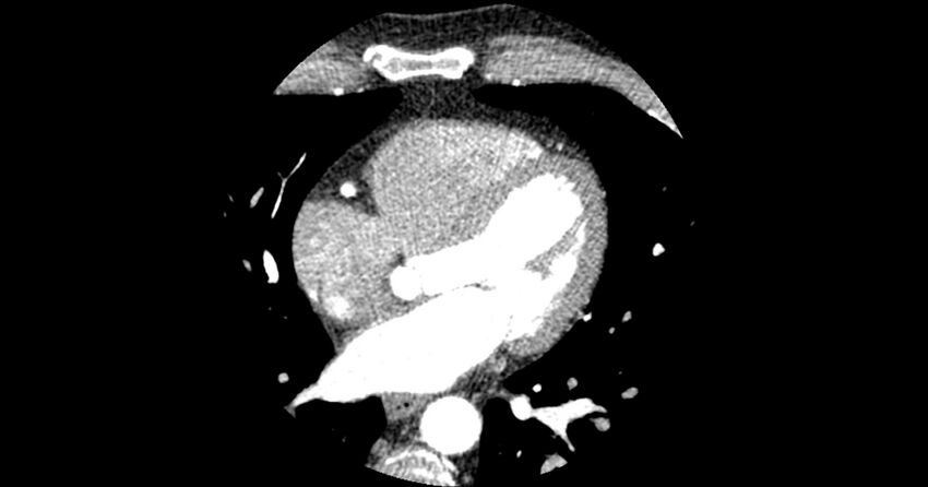 Aberrant left main coronary artery (ALMCA) arising from the right sinus with interarterial course (Radiopaedia 63251-71814 Axial C+ arterial phase 99).JPG