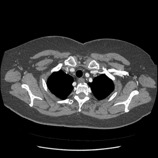 File:Aberrant right subclavian and left vertebral arteries (Radiopaedia 43467-46847 Axial C+ portal venous phase 17).jpg