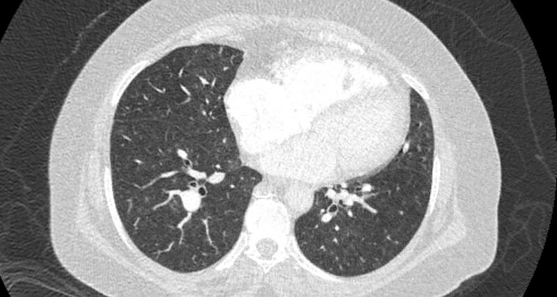 File:Accessory right inferior hepatic vein (Radiopaedia 65245-74259 Axial lung window 48).jpg
