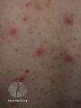Acne affecting the back images (DermNet NZ acne-acne-back-174).jpg