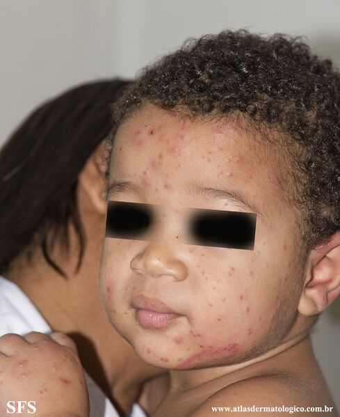 File:Acrodermatitis Infantile Papular (Dermatology Atlas 16).jpg