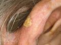 Actinic keratoses (DermNet NZ lesions-s-sk4).jpg
