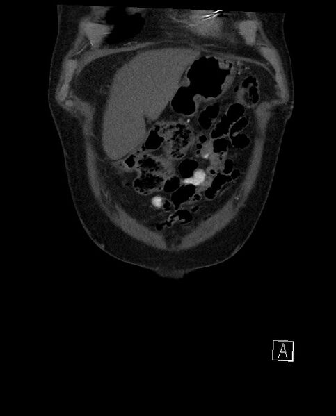 File:Active lower gastrointestinal bleeding - diverticular (Radiopaedia 61203-69106 Coronal C+ arterial phase 17).jpg
