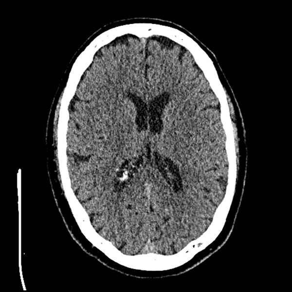 File:Acute A3 occlusion with ACA ischemic penumbra (CT perfusion) (Radiopaedia 72036-82525 Axial non-contrast thins 51).jpg
