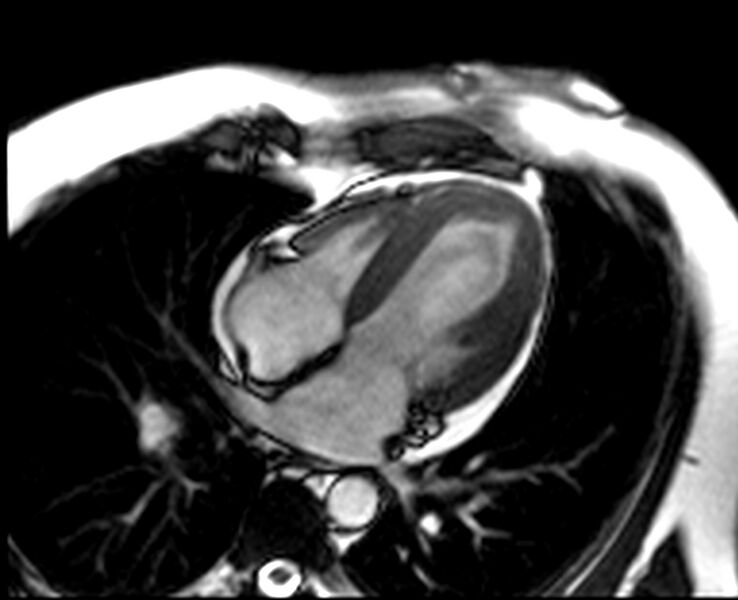 File:Acute anteroseptal myocardial infarction (Radiopaedia 68409-77944 Four chambers view SSFP cine 14).jpg