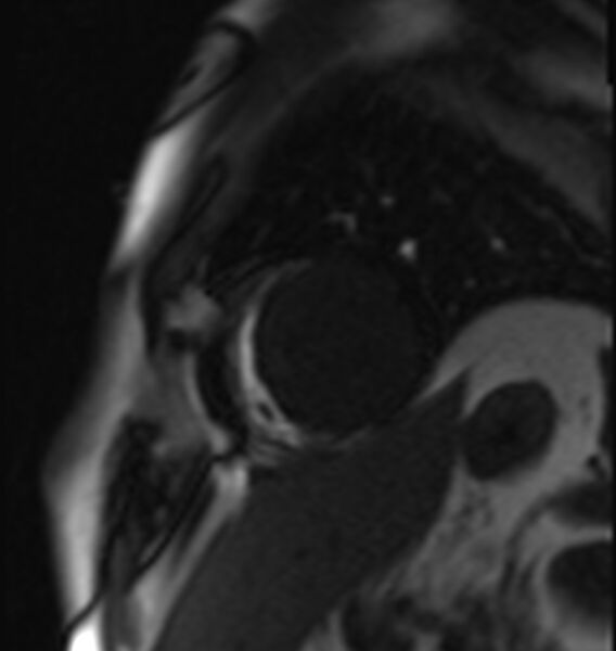 File:Acute anteroseptal myocardial infarction (Radiopaedia 68409-77945 Short axis (mid ventricular) Perfusion 6).jpg
