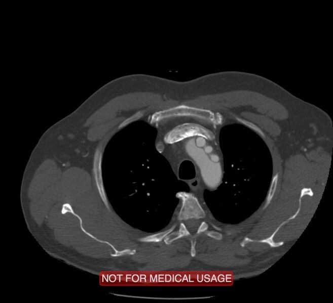 File:Acute aortic dissection - Stanford type A (Radiopaedia 40661-43285 Axial C+ arterial phase 1).jpg