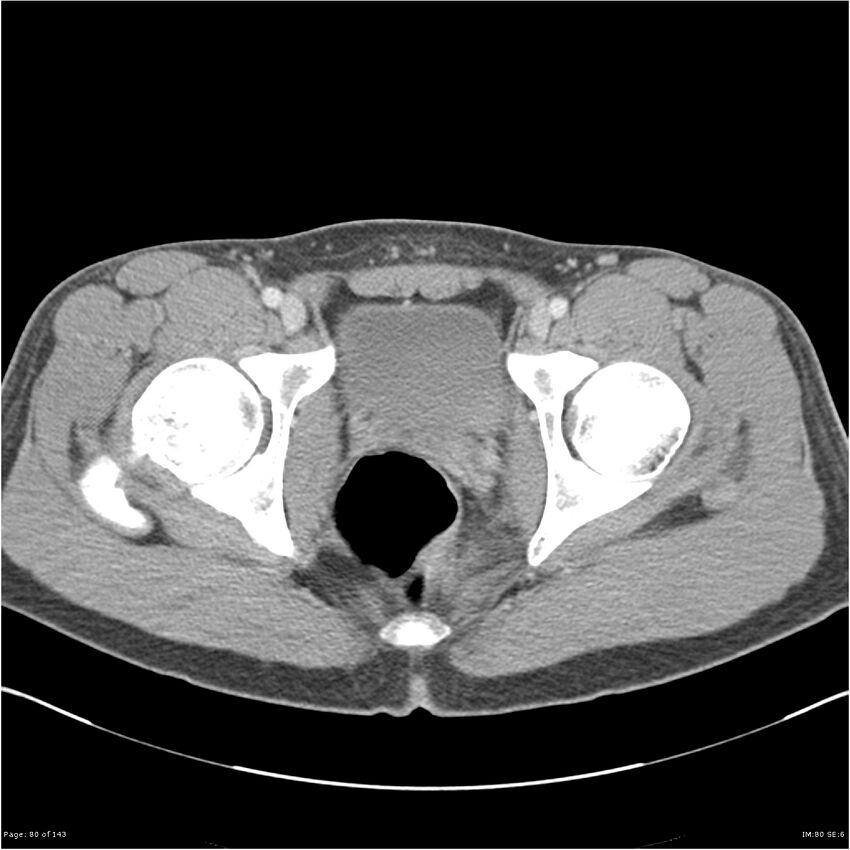 Acute appendicitis (Radiopaedia 25364-25615 B 70).jpg