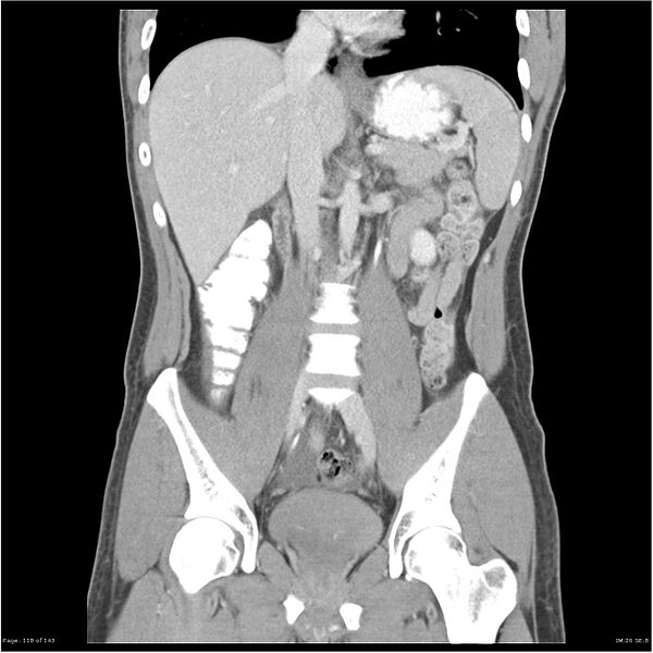 File:Acute appendicitis (Radiopaedia 25364-25615 C+ portal venous phase 15).jpg