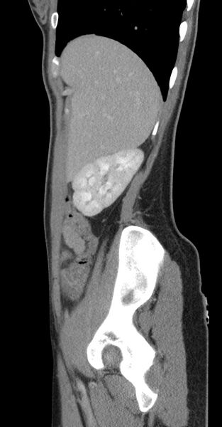 File:Acute appendicitis (Radiopaedia 62608-70901 Sagittal C+ portal venous phase 48).jpg