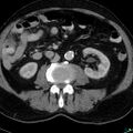 Acute appendicitis arising from a malrotated cecum (Radiopaedia 19970-19997 Axial C+ portal venous phase 16).jpg