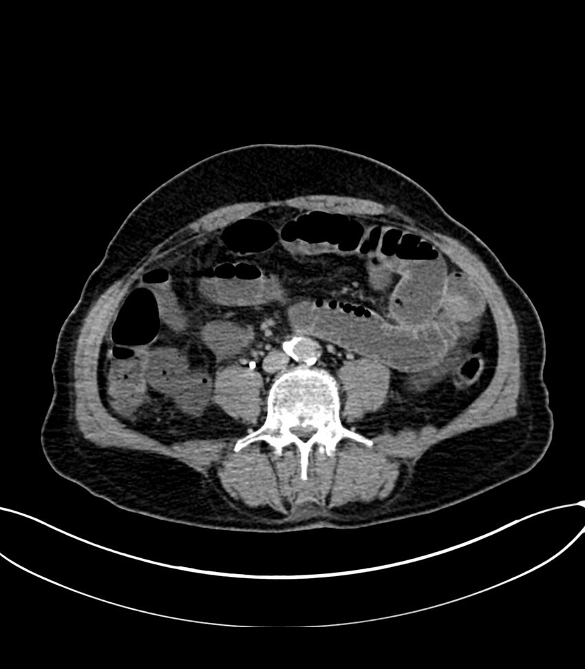 Acute arterial mesenteric ischemia (Radiopaedia 78238-90828 Axial C+ delayed 84).jpg