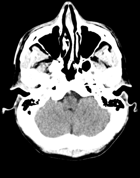 File:Acute disseminated encephalomyelitis (ADEM) (Radiopaedia 65319-74348 Axial C+ delayed 6).png