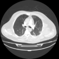 Acute heart failure (CT) (Radiopaedia 79835-93075 Axial lung window 19).png