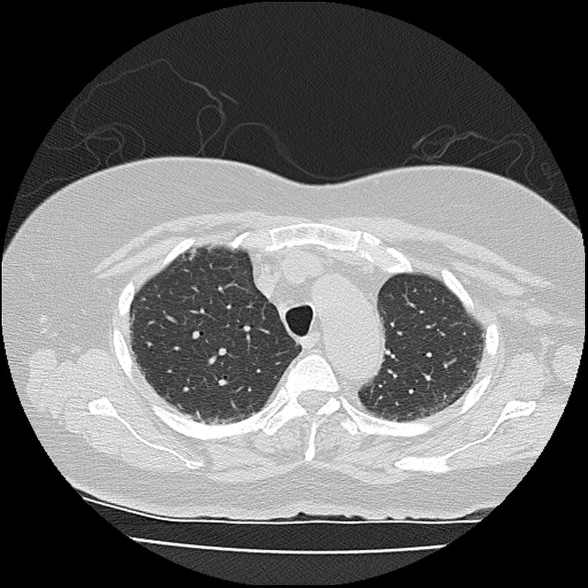 Acute interstitial pneumonitis (Radiopaedia 45404-49452 Axial lung window 22).jpg