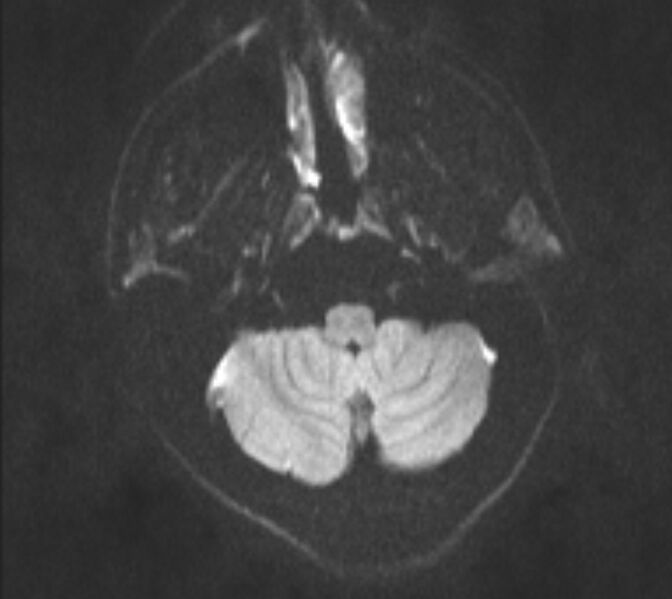 File:Acute ischemic stroke - posterior circulation territory (Radiopaedia 77670-89880 Axial DWI 27).jpg