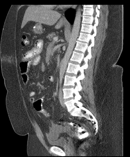 File:Acute mesenteric venous ischemia (Radiopaedia 46041-50383 Sagittal C+ portal venous phase 62).jpg