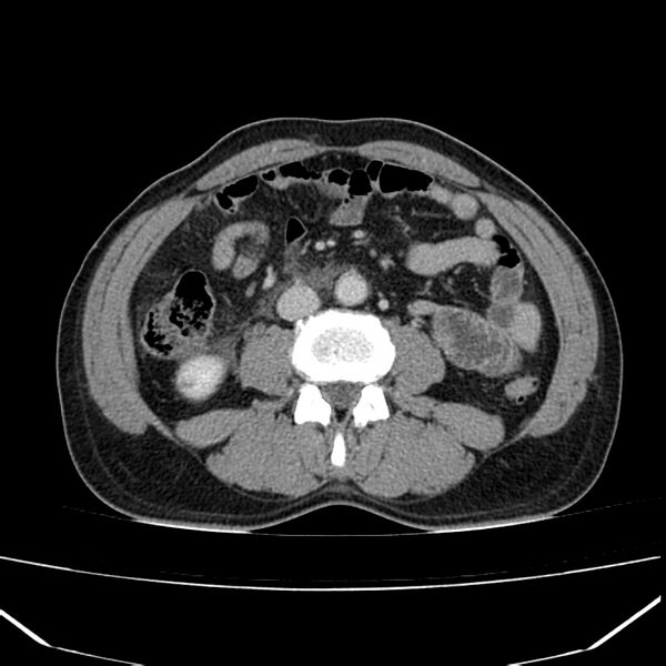 File:Acute pancreatitis (Radiopaedia 22572-22596 Axial C+ portal venous phase 40).jpg