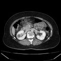 Acute pancreatitis - Balthazar C (Radiopaedia 26569-26714 Axial C+ portal venous phase 43).jpg