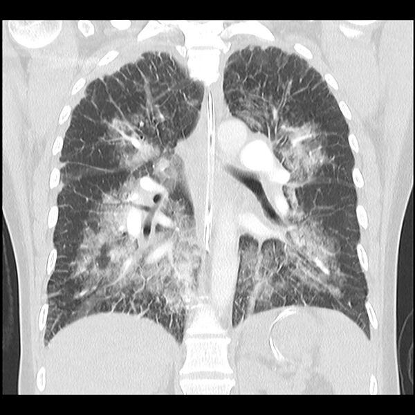File:Acute pulmonary edema on CT (Radiopaedia 33582-34672 Coronal lung window 23).jpg