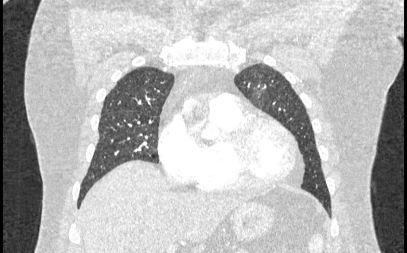 File:Acute pulmonary embolism with pulmonary infarcts (Radiopaedia 77688-89908 Coronal lung window 17).jpg