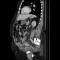 Acute pyelonephritis (Radiopaedia 25657-25837 Sagittal renal parenchymal phase 51).jpg