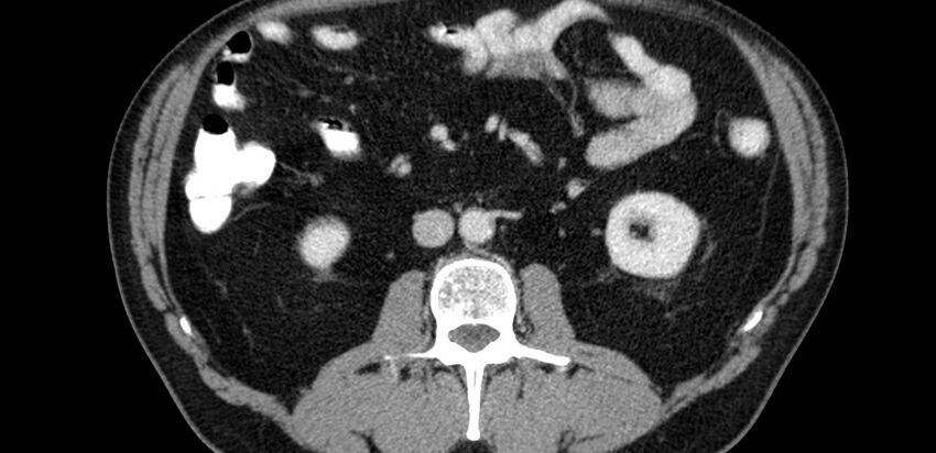 Acute sigmoid colon diverticulitis (Radiopaedia 55507-61976 Axial C+ portal venous phase 10).jpg