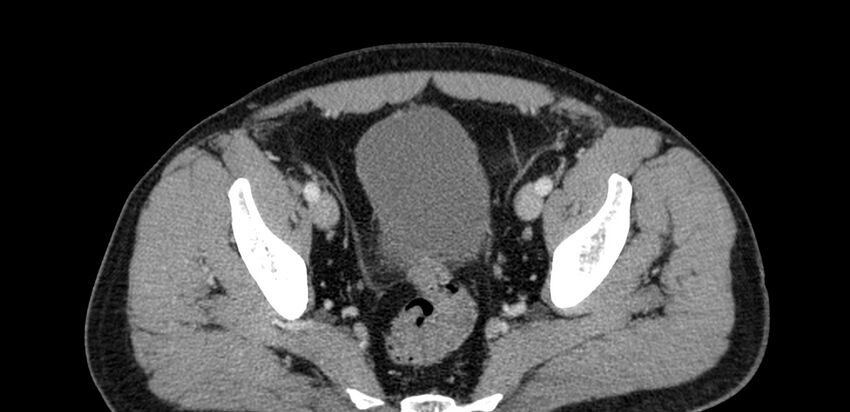 Acute sigmoid colon diverticulitis (Radiopaedia 55507-61976 Axial C+ portal venous phase 98).jpg