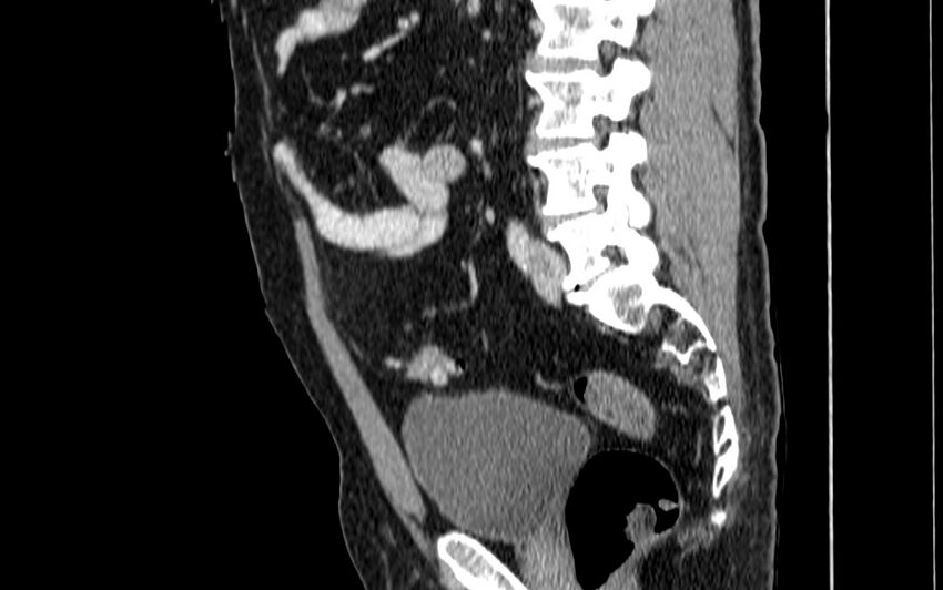 Acute sigmoid colon diverticulitis (Radiopaedia 55507-61976 Sagittal C+ portal venous phase 17).jpg