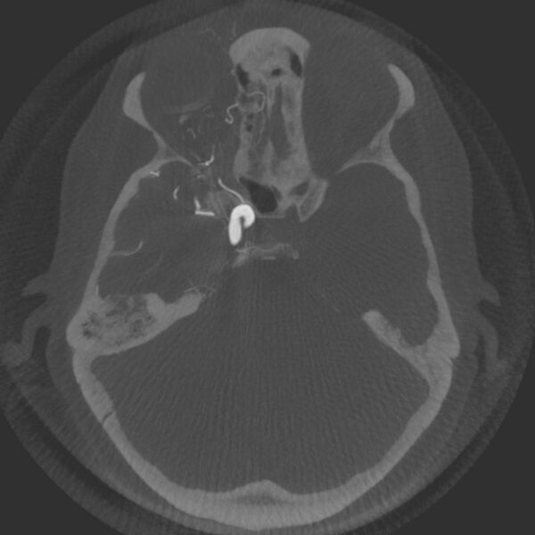 File:Acute subarachnoid hemorrhage and accessory anterior cerebral artery (Radiopaedia 69231-79010 Axial arterial - MIP 24).jpg