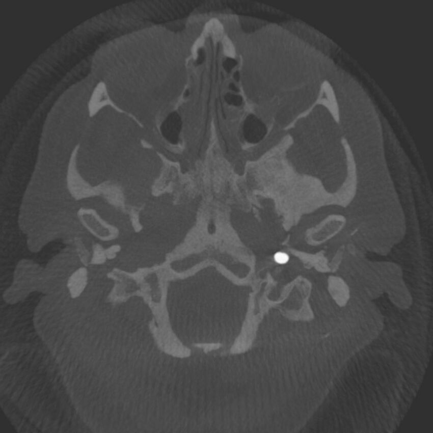 Acute subarachnoid hemorrhage and accessory anterior cerebral artery (Radiopaedia 69231-79010 C 3).jpg