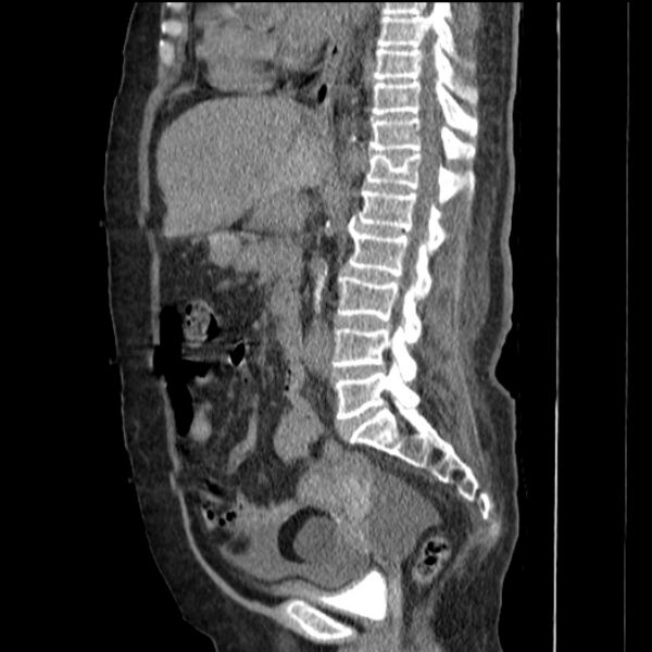 File:Acute tubular necrosis (Radiopaedia 28077-28334 H 45).jpg