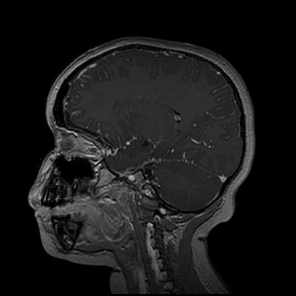 File:Adamantinomatous craniopharyngioma (Radiopaedia 77407-89529 H 76).jpg