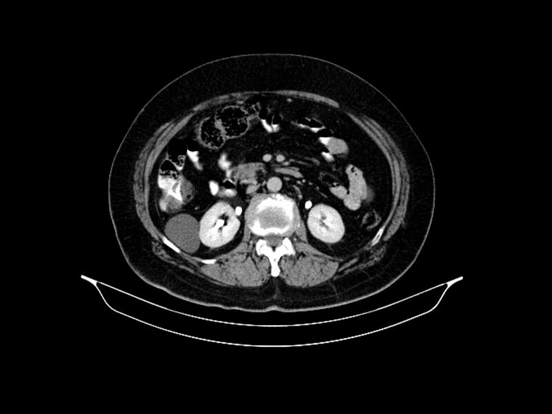 File:Adenocarcinoma of pancreas with hepatic metastasis (Radiopaedia 64332-73122 Axial C+ delayed 46).jpg