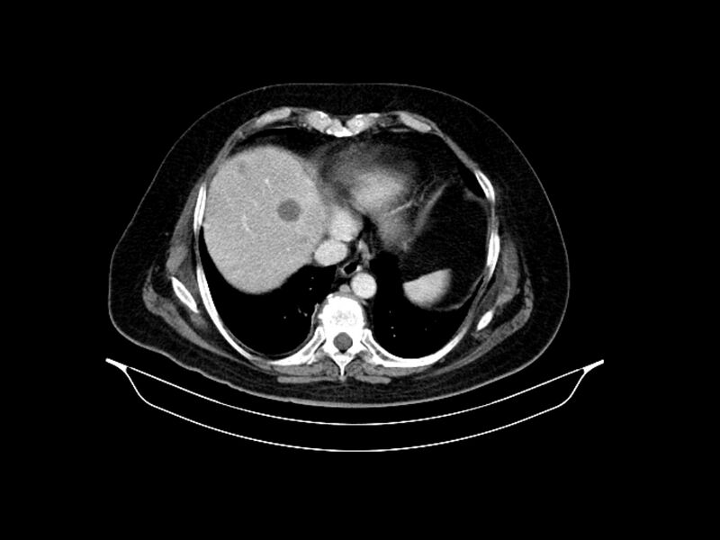 File:Adenocarcinoma of pancreas with hepatic metastasis (Radiopaedia 64332-73122 Axial C+ portal venous phase 15).jpg