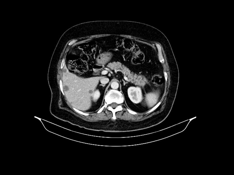 File:Adenocarcinoma of pancreas with hepatic metastasis (Radiopaedia 64332-73122 Axial C+ portal venous phase 33).jpg
