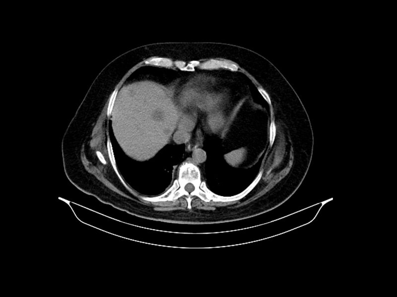 File:Adenocarcinoma of pancreas with hepatic metastasis (Radiopaedia 64332-73122 Axial non-contrast 16).jpg