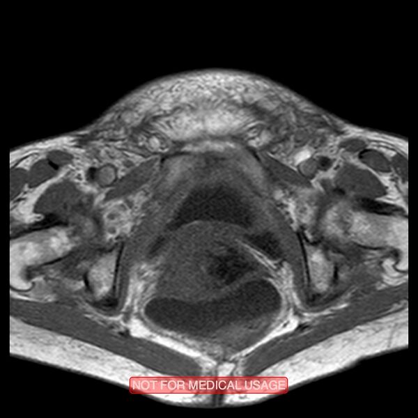 File:Adenocarcinoma of the cervix (Radiopaedia 28373-28615 Axial T1 6).jpg