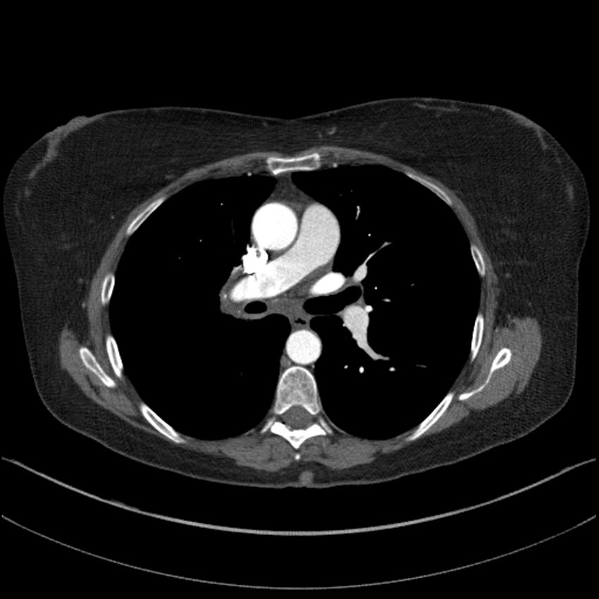 Adenocarcinoma of the lung (Radiopaedia 44205-47803 Axial C+ portal venous phase 40).jpg