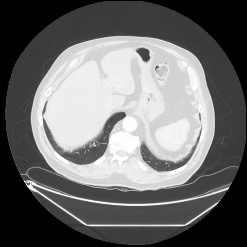 Adenocarcinoma of the lung (Radiopaedia 44876-48759 Axial lung window 71).jpg