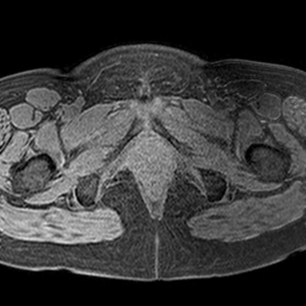 File:Adenomyoma of the uterus (Radiopaedia 9871-10439 Axial T1 fat sat 3).jpg