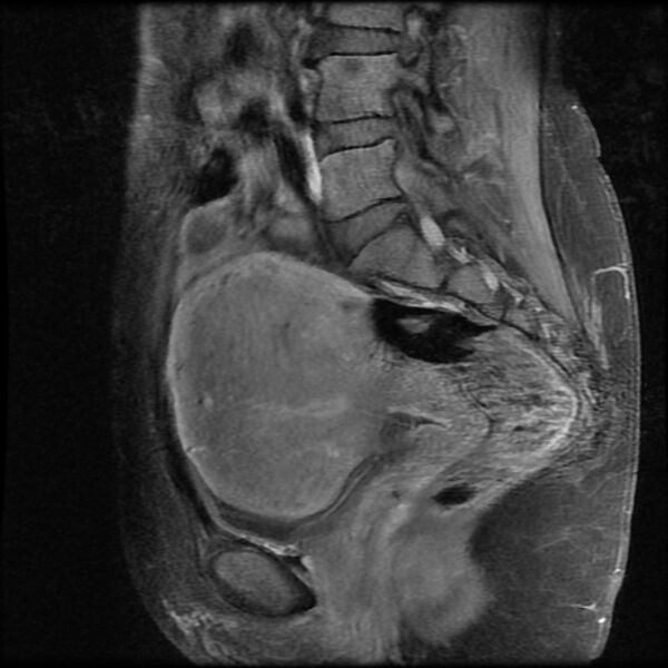File:Adenomyosis on MRI (Radiopaedia 29328-29780 Sagittal T1 C+ fat sat 10).jpg