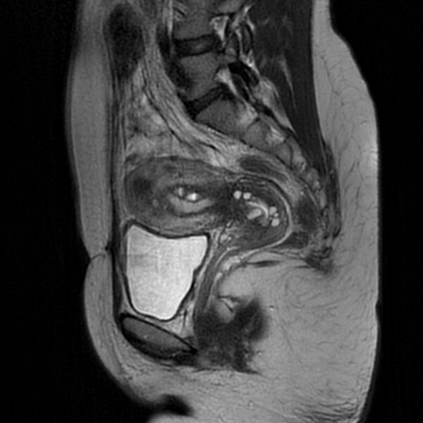 File:Adenomyosis within a septate uterus (Radiopaedia 69963-79981 Sagittal T2 18).jpg