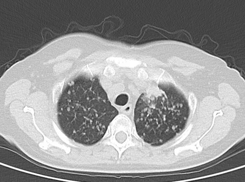 File:Adenosquamous lung carcinoma (Radiopaedia 22035-22030 lung window 18).jpg
